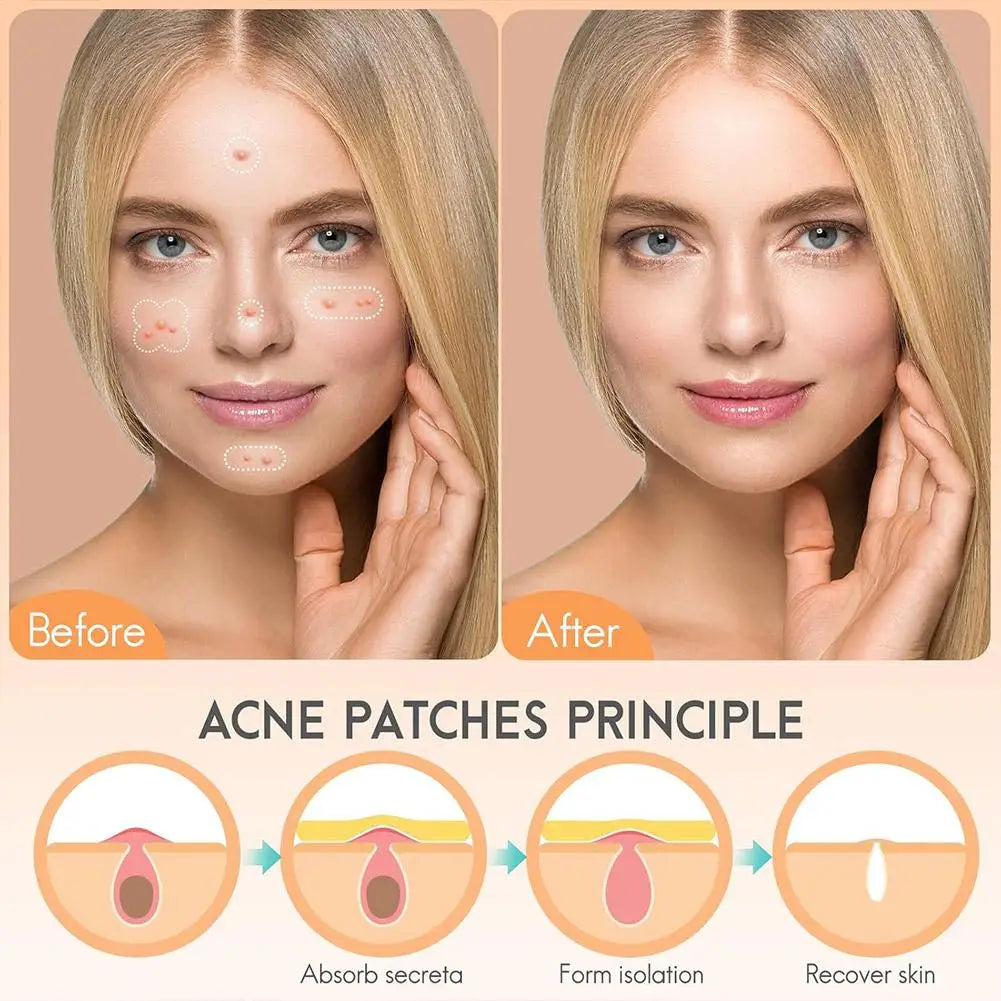 Hydrocolloid Acne Patches Pimple Patches for Face 264pcs Round Shape Spot Stickers Zit Covers for Women